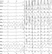 Gráfico que muestra 16 trazas de tensión que van a través de la página de izquierda a derecha, cada uno mostrando una señal diferente. En el centro de la página todos los rastros de repente empieza a mostrar los picos bruscos afilados, que continúan hasta el final de la trama.