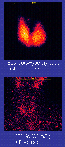 Imagen superior: dos características de gotas como se fusionaron en sus partes inferiores; tienen un centro de color amarillo y un borde rojo sobre un fondo negro. Leyenda: Graves Enfermedad Tc-La captación del 16%. Baje la imagen: puntos rojos sobre fondo negro. Pie de foto: 250 Gy (30 mCi) + Prednison.