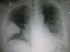 Una radiografía: mostrando una cuña blanca en el campo pulmonar derecho de una radiografía de tórax.