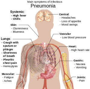 Un diagrama del cuerpo humano delineando los síntomas principales de la neumonía