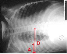 Una radiografía de tórax muestra una mentira horizontal. El área de color negro inferior, que es el pulmón derecho es más pequeño con un área más blanca debajo de un derrame pulmonar. Hay flechas rojas marcan el tamaño de estos.