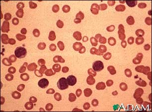 Chronic lymphocytic leukemia - microscopic view