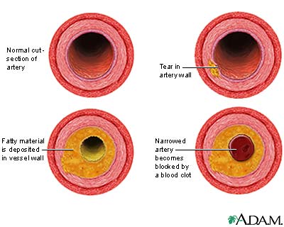 Developmental process of atherosclerosis