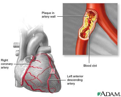 Atherosclerosis