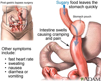 Dumping syndrome