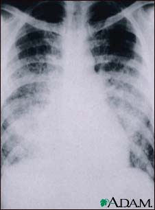 Chickenpox, acute pneumonia - chest X-ray