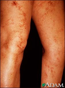 Livedo reticularis on the legs