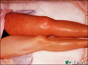 Deep venous thrombosis, ileofemoral