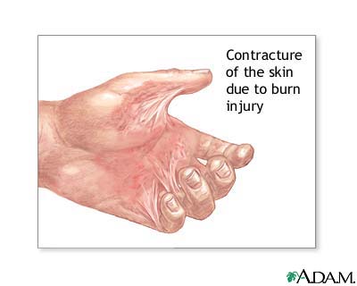 Contracture deformity