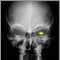 Neurofibromatosis I, enlarged optic foramen