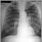 Adenocarcinoma - chest X-ray