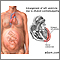 Peripartum cardiomyopathy