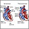 Truncus arteriosus